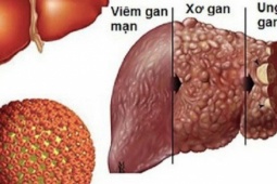 Sức khỏe đời sống - Người đàn ông ở Hà Nội men gan cao gấp 34 lần vì dùng thuốc theo thói quen của rất nhiều người Việt