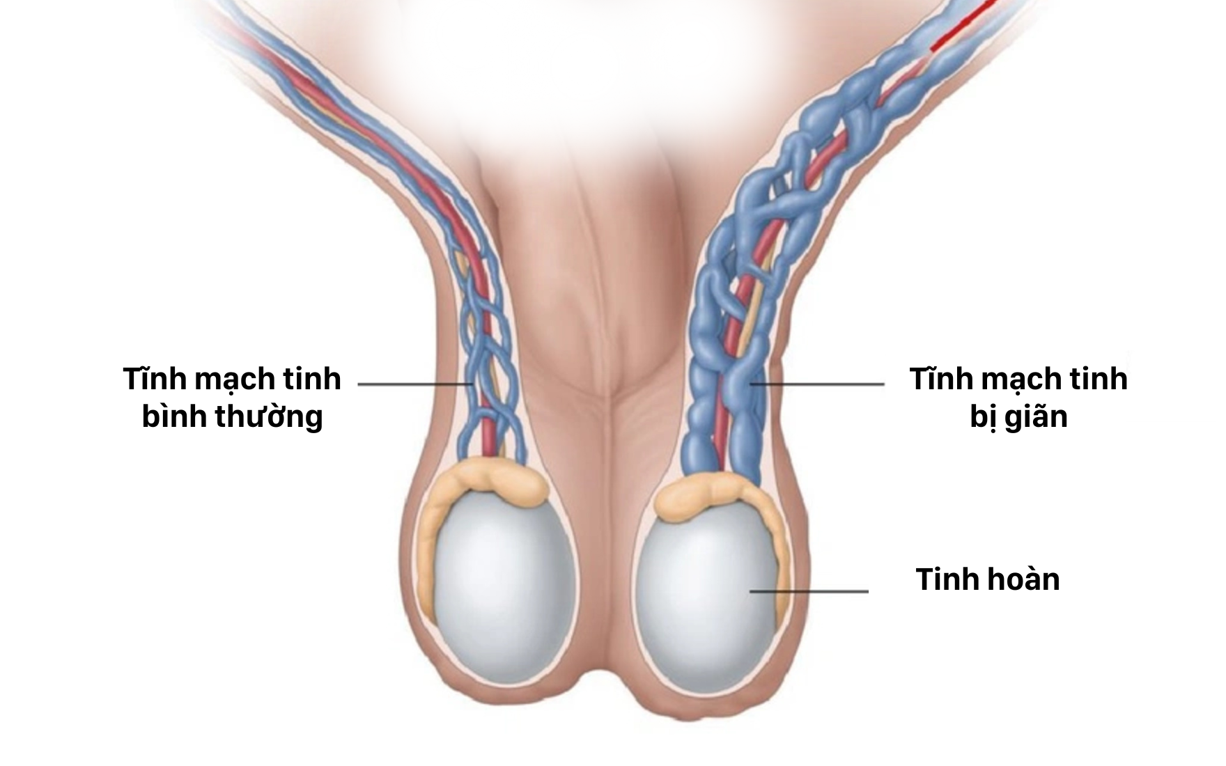 Luồng máu trào ngược về tinh hoàn gây giãn tĩnh mạch thừng tinh