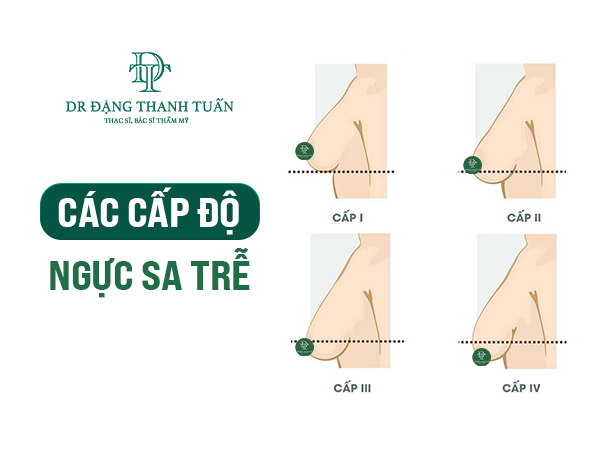 Các cấp độ sa trễ phổ biến hiện nay