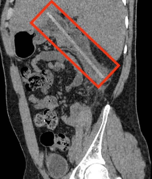 Hình ảnh CT cho thấy dị vật nằm trong cơ thể của bệnh nhân