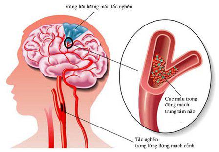 Đột quỵ (stroke) còn gọi là tai biến mạch máu não thường xảy ra đột ngột khi nguồn máu cung cấp cho não bị tắc nghẽn, gián đoạn hoặc suy giảm.