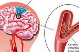 Những thói quen xấu khiến bạn dễ bị đột quỵ