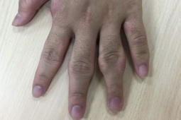 Sức khỏe đời sống - Thích bẻ ngón tay, bàn tay của chàng trai trẻ biến dạng gây sốc