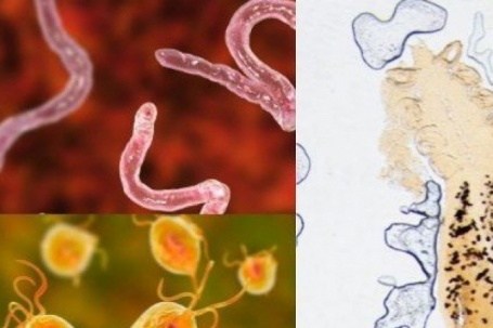 Ho ra máu cảnh giác với sán lá phổi