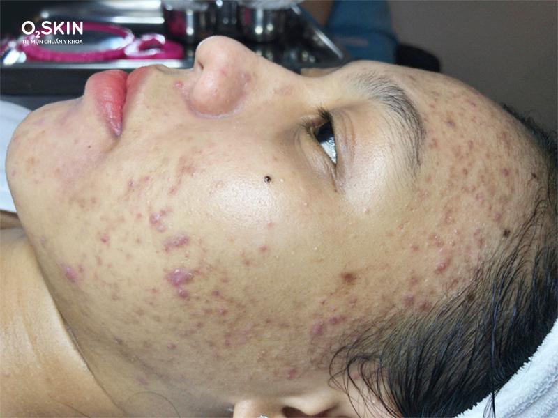 Sau thời gian sử dụng thuốc Bắc để trị mụn, làn da của Tuyết Trinh thường xuyên xuất hiện cảm giác đau và ngứa.