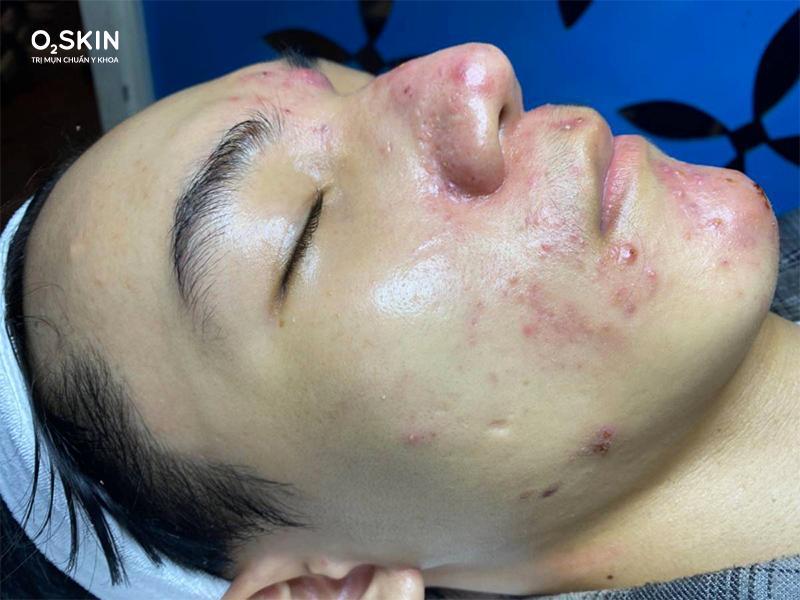 Thuốc rượu khiến Thanh Nhật bị tổn hại nặng nề, khiến bạn bị đau rát khó chịu mỗi khi rửa mặt.