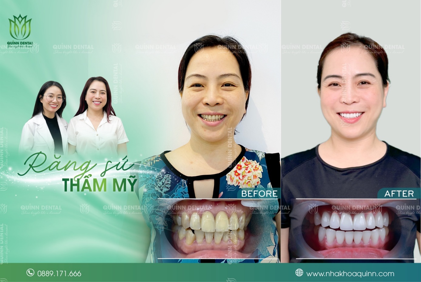 Quinn Dental – Nha khoa phục hình răng sứ uy tín tại Việt Nam - 2