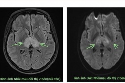 Đau đầu không đi khám, tự uống thuốc, người phụ nữ bị đột quỵ não