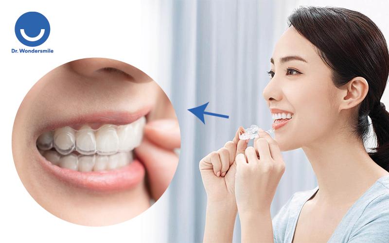 Khay trong suốt mang giá trị thẩm mỹ cao ngay cả khi niềng, giúp người bệnh tự tin, thoải mái giao tiếp.
