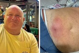 Sức khỏe đời sống - Vết cắn tử thần: Kỳ nghỉ biến thành ác mộng vì một con nhện