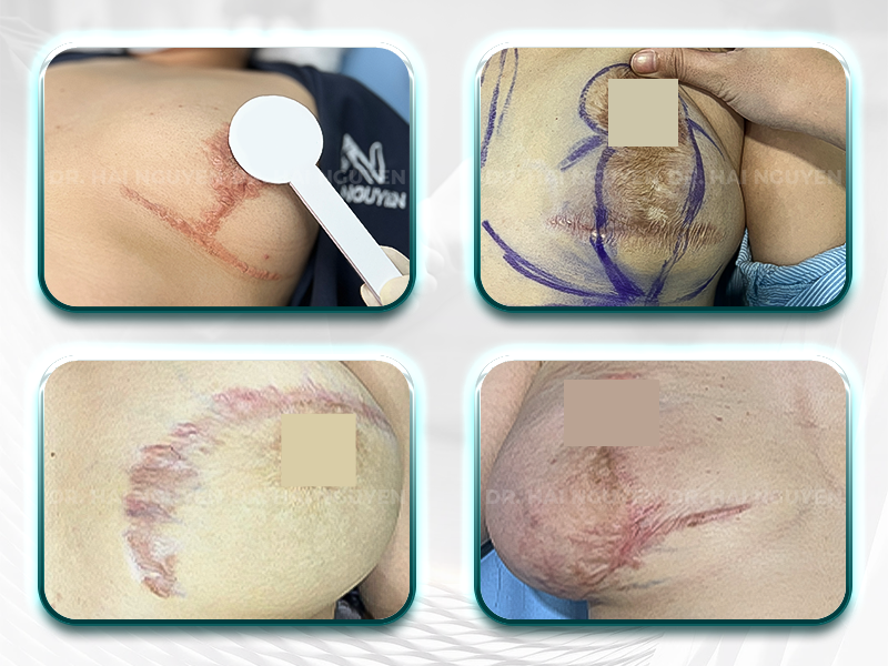 Vết sẹo hình thành sau treo sa trễ nguyên nhân chính đến từ kỹ thuật mổ và chuyên môn của bác sĩ