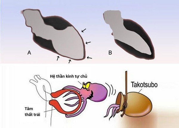 Hình ảnh (A) mỏm tim trái giãn rộng, phình lên giống chiếc bình trong bệnh Takotsubo so với (B) là bình thường.