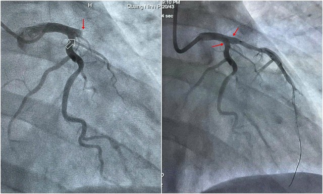 Hình ảnh mạch vành bị tắc hoàn toàn được đặt stent tái thông thành công.