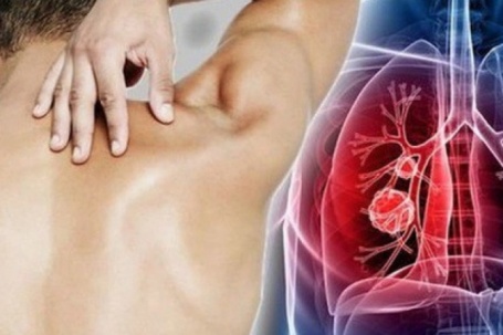 Người đàn ông 29 tuổi bất ngờ phát hiện ung thư phổi, thừa nhận có một...