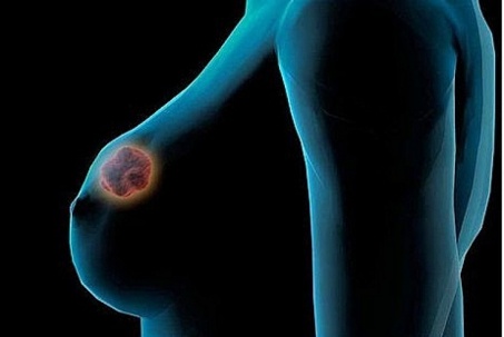 Đang mang thai mắc ung thư vú, điều trị hóa chất có ảnh hưởng đến thai...