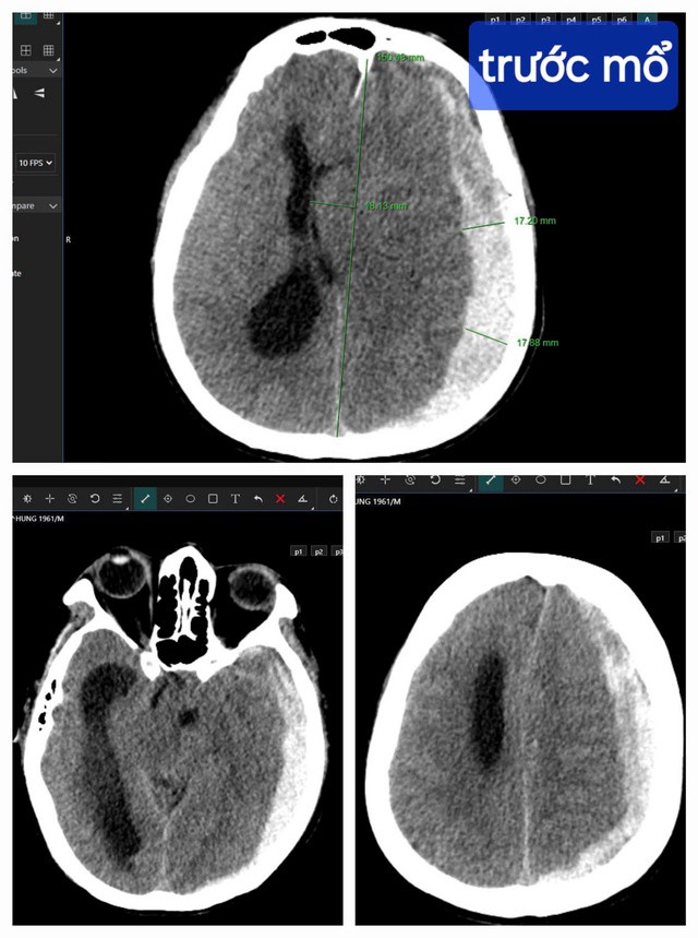 Kết quả chụp CT cho thấy bệnh nhân bị tụ máu dưới màng cứng bán cầu não trái, thoát vị qua liềm đại não sang phải.