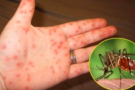 5 lưu ý cực kỳ quan trọng để phòng ngừa sốt xuất huyết sau mùa mưa lũ