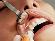 Đi khám răng phát hiện ra bệnh tiểu đường