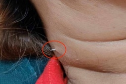 Xương cá mắc trong cổ họng, 2 tuần sau đâm xuyên qua cổ người phụ nữ