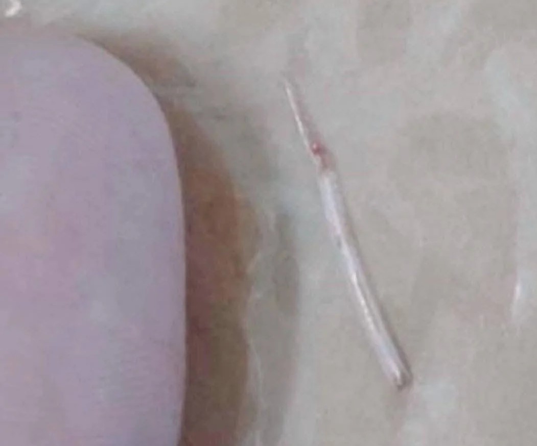 Mảnh xương cá được gắp ra.
