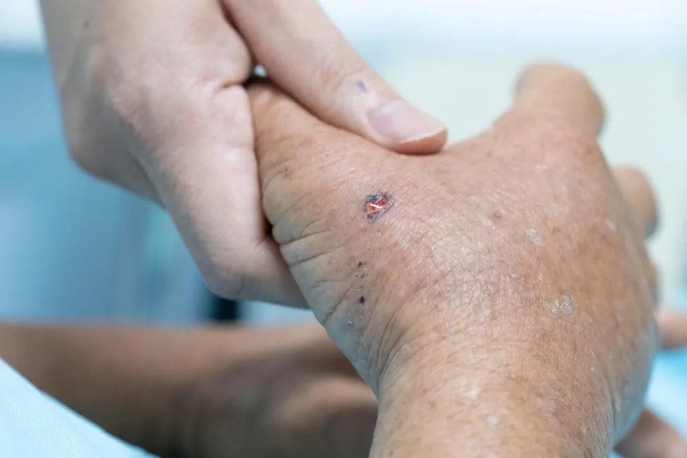 Một trong những vết thương do ong vò vẽ đốt trên tay ông D.