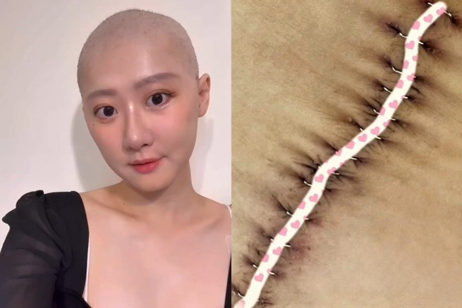 Lâm Mạt Tinh phải cạo trọc đầu, bụng có sẹo dài sau ca phẫu thuật ung thư. Ảnh: Weibo