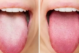 7 triệu chứng thầm lặng của ung thư đầu cổ
