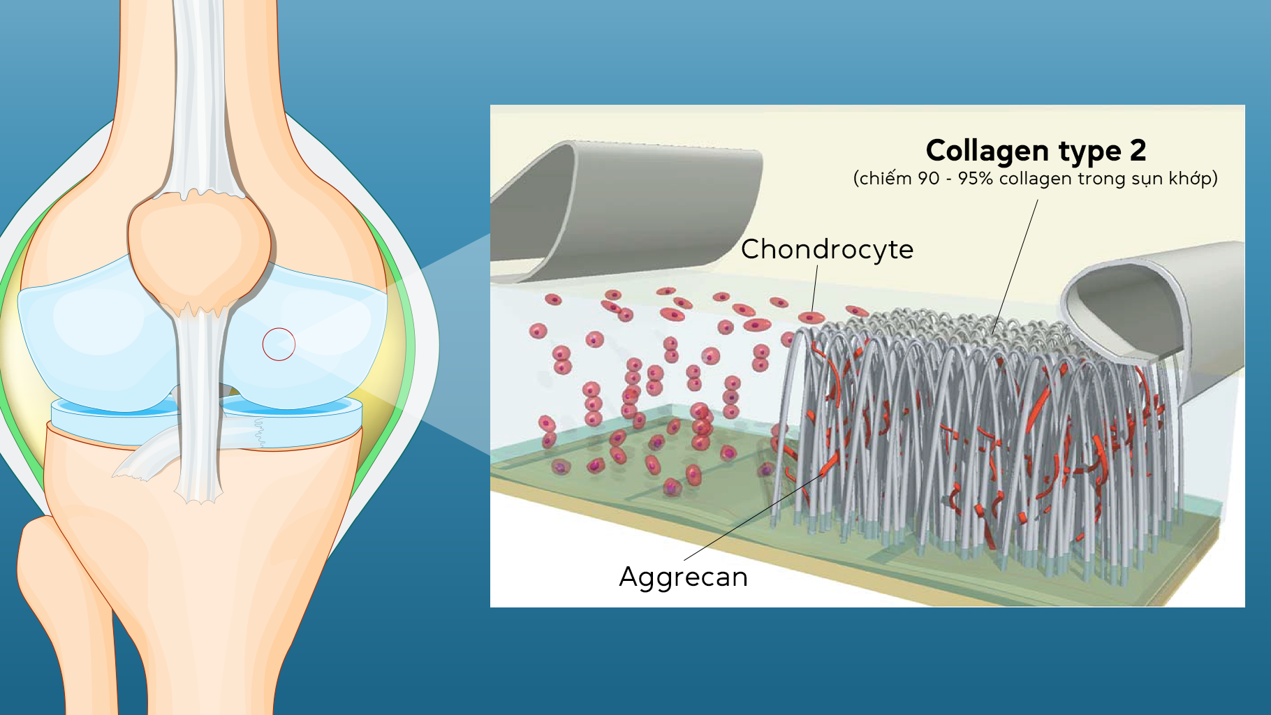 Tổn thương sụn khớp ở người chơi thể thao quá tải: Glucosamine hay Collagen type 2 không biến tính (Collavant n2) phù hợp hơn? - 1