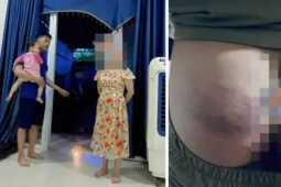 Làm rõ vụ học sinh bị cô giáo đánh nghi do làm nhầm bài tập