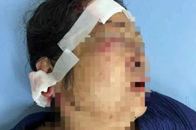 Người phụ nữ nhập viện với nhiều vết thương. Ảnh: CACC