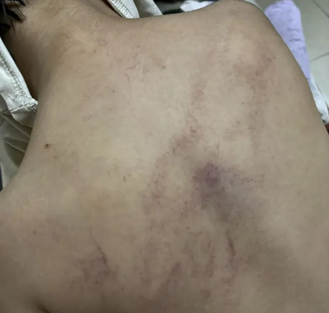 Gia đình phát hiện lưng của con tím bầm một mảng sau khi đi học từ ở trường.