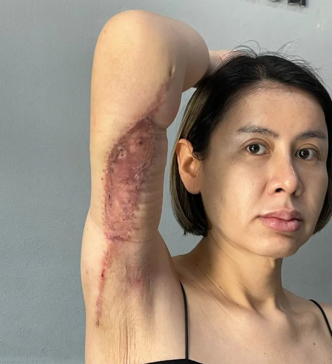Sau phẫu thuật, vùng da dưới cánh tay của Apinan chuyển sang màu tím cùng những vết lõm sâu.