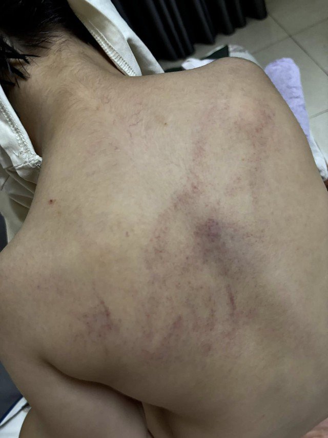 Cháu T.K.L. với nhiều vết bầm tím sau lưng nghi do bị giáo viên bạo hành.