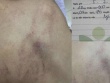 Vụ trẻ nghi bị cô giáo bạo hành: Cơ quan chức năng lên tiếng