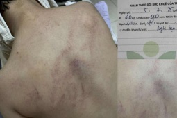 Vụ trẻ nghi bị cô giáo bạo hành: Cơ quan chức năng lên tiếng