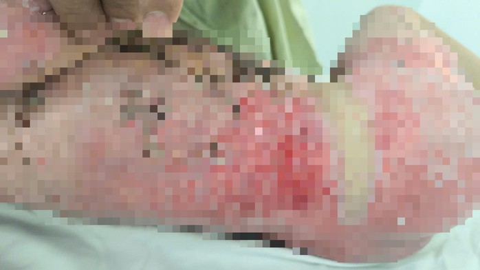 Sau ghép da 2 tuần, vết phỏng đã dần hồi phục