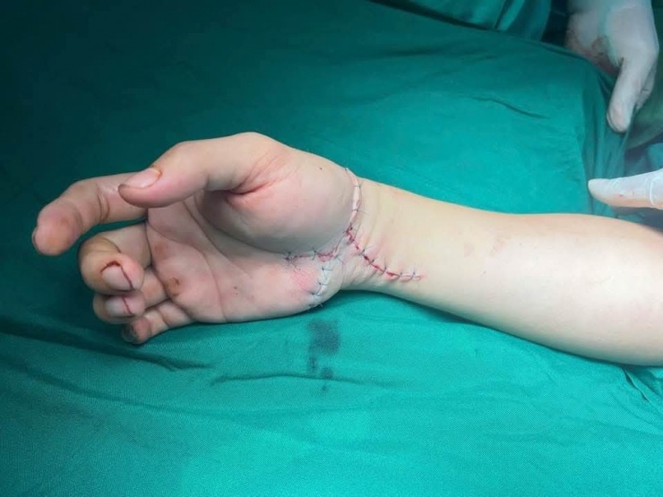 Cánh tay của bệnh nhân sau phẫu thuật. Ảnh: BSCC