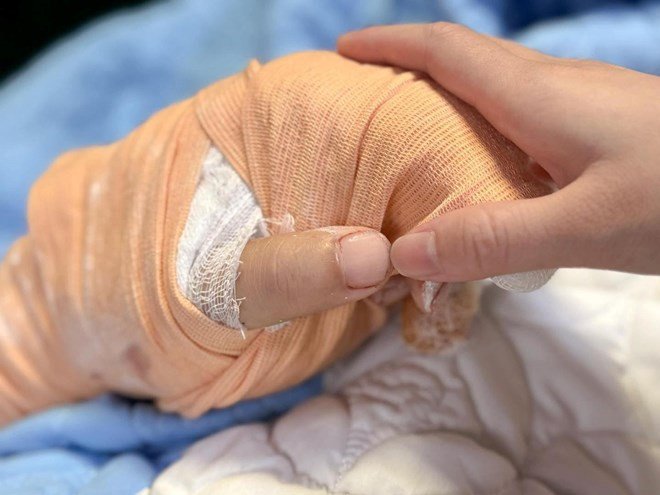 Bàn tay của TikToker tên N.H đã được nối lại thành công. Ảnh: BSCC