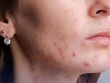 4 dấu hiệu trên gương mặt cảnh báo gan nhiễm mỡ