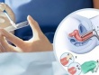 Cách tốt nhất để phát hiện sớm ung thư cổ tử cung