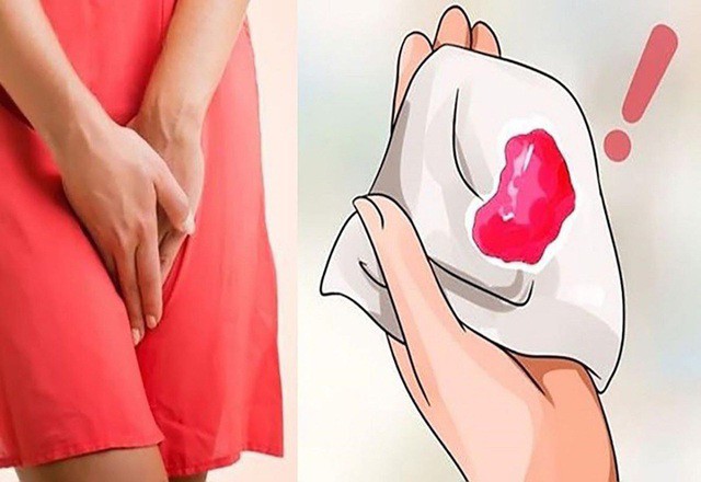 Chảy máu âm đạo bất thường là dấu hiệu phổ biến cảnh báo ung thư cổ tử cung.