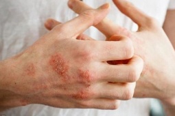 Giải mã bệnh chàm: Nguyên nhân, triệu chứng và phương pháp điều trị hiệu quả