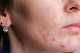 4 dấu hiệu trên gương mặt cảnh báo gan nhiễm mỡ