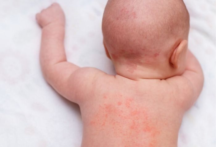 Bệnh chàm thường dễ gặp nhất ở trẻ em