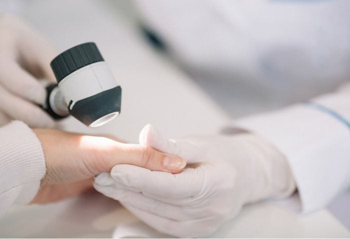 Bệnh chàm cần được chẩn đoán và điều trị bởi bác sĩ da liễu