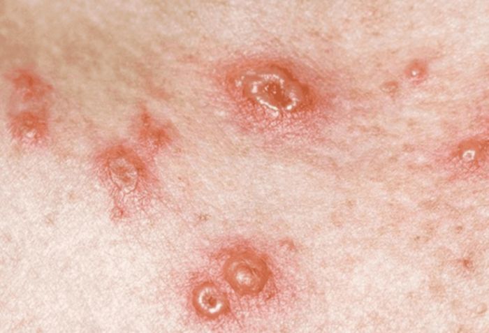 Xuất hiện mảng da đỏ, sưng, rỉ dịch hoặc có vảy