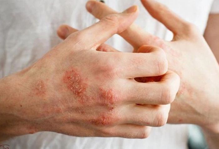 Da khô, nứt nẻ, ngứa vào ban đêm