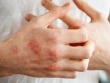 Giải mã bệnh chàm: Nguyên nhân, triệu chứng và phương pháp điều trị hiệu quả