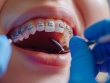 Giải pháp niềng răng hô hiệu quả tại Nha khoa Đăng Lưu