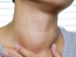 4 biểu hiện vùng cổ là tín hiệu sớm của ung thư
